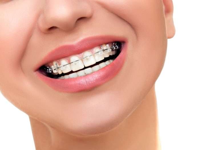 Выравнивание зубов и брекеты